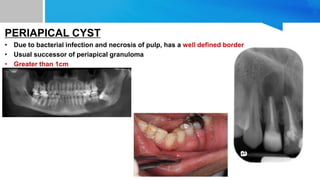 PERIAPICAL CYST
• Due to bacterial infection and necrosis of pulp, has a well defined border
• Usual successor of periapical granuloma
• Greater than 1cm
 