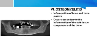 VI. OSTEOMYELITIS
• Inflammation of bone and bone
marrow
• Occurs secondary to the
inflammation of the soft tissue
components of the bone
 