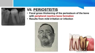 VII. PERIOSTEITIS
• Focal gross thickening of the periosteum of the bone
with peripheral reactive bone formation
• Results from mild irritation or infection
 
