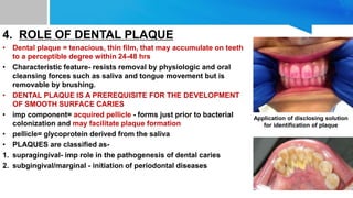 4. ROLE OF DENTAL PLAQUE
• Dental plaque = tenacious, thin film, that may accumulate on teeth
to a perceptible degree within 24-48 hrs
• Characteristic feature- resists removal by physiologic and oral
cleansing forces such as saliva and tongue movement but is
removable by brushing.
• DENTAL PLAQUE IS A PREREQUISITE FOR THE DEVELOPMENT
OF SMOOTH SURFACE CARIES
• imp component= acquired pellicle - forms just prior to bacterial
colonization and may facilitate plaque formation
• pellicle= glycoprotein derived from the saliva
• PLAQUES are classified as-
1. supragingival- imp role in the pathogenesis of dental caries
2. subgingival/marginal - initiation of periodontal diseases
Application of disclosing solution
for identification of plaque
 