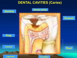 DENTAL CAVITIES (Caries)
Enamel
Dentine
Pulp
Root
Furcation
Cement
Ligament
Dental cavity
 