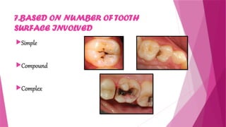 Dental Caries with classification etiology and management | PPTX