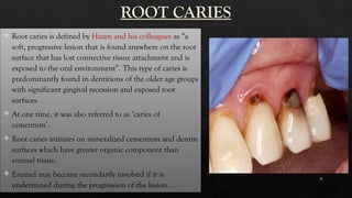 Code Caries Root Dental caries ppt of prosthodontics(DMS) | PPTX