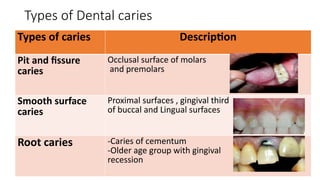 Caries Classification In Depth DENTAL CARIES (types, classification and examination ) | PPTX