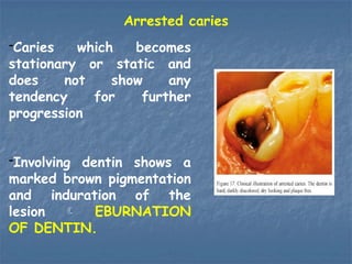 Static Caries Dental Caries-Ayoub.pdf_68607.pptxsjsjan | PPTX