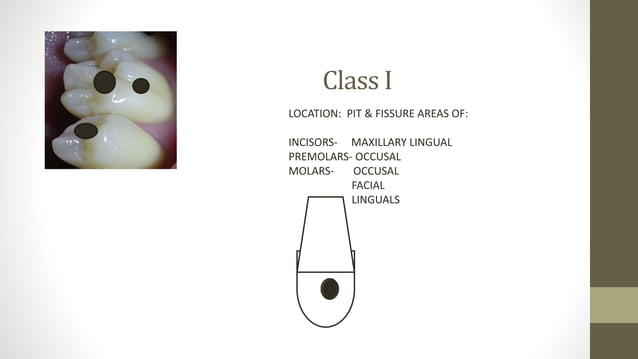 Dental caries- etiology clinical features histopathology and caries ...