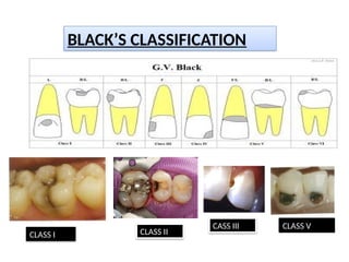 DENTAL CARIES - Classification And Theories.pptx