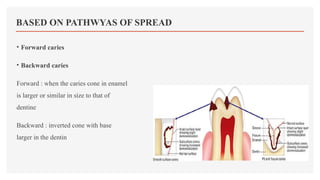 DENTAL CARIES[1].pptx related to dental decay | PPTX