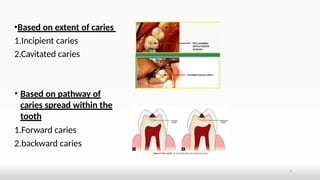 dental caries guide to oral health1.pptx