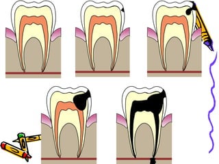 Dental caries ppt | PPT