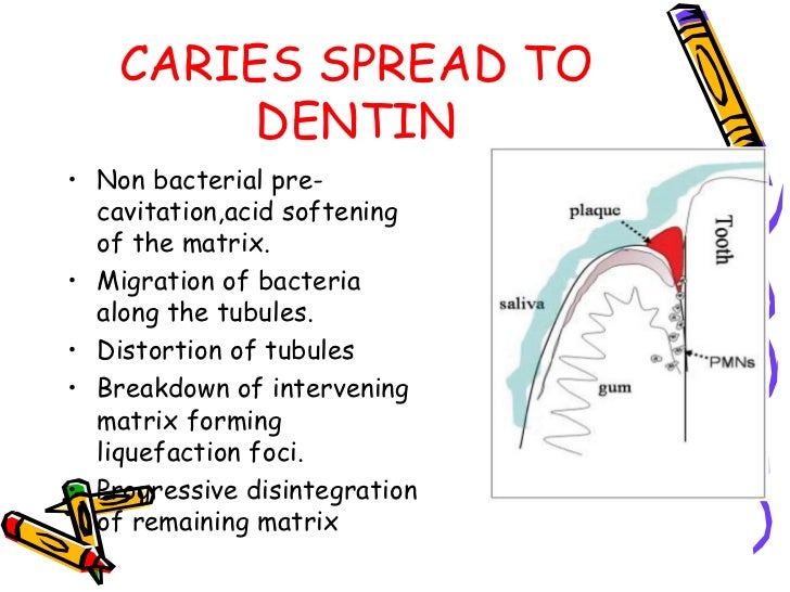 Dental caries ppt