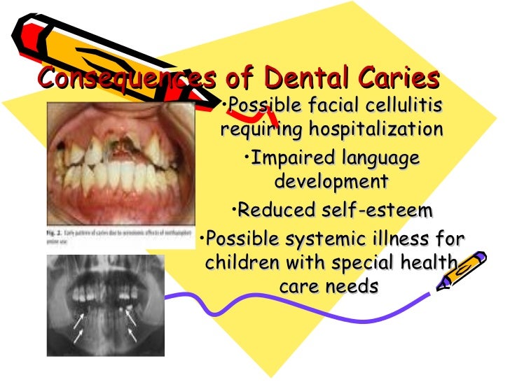early-childhood-caries-dr-trynaadh