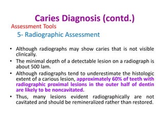 Dental Caries | PPTX