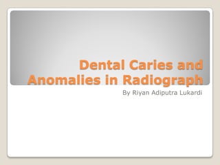 Dental Caries and
Anomalies in Radiograph
            By Riyan Adiputra Lukardi
 