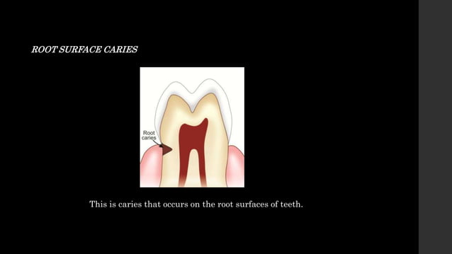 Dental Caries classification & Microbiology | PPTX