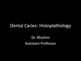 Dental Caries- Histoplathology
Dr. Rhythm
Assistant Professor
 