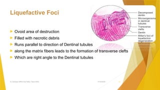 DENTAL CARIES lecture description it's prevention | PPTX