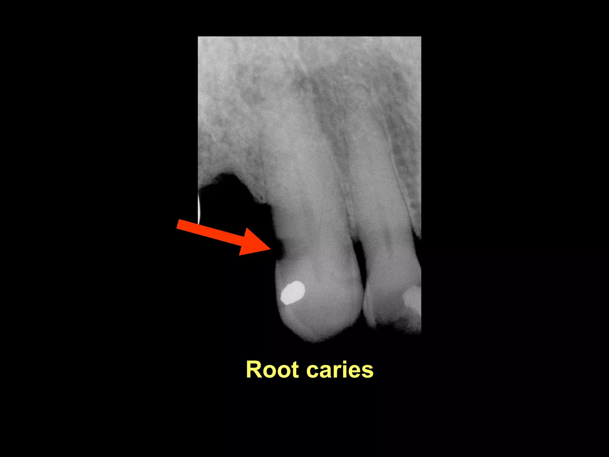 Radiographic Diagnosis of Dental Caries | PDF