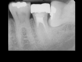 Radiographic Diagnosis of Dental Caries 