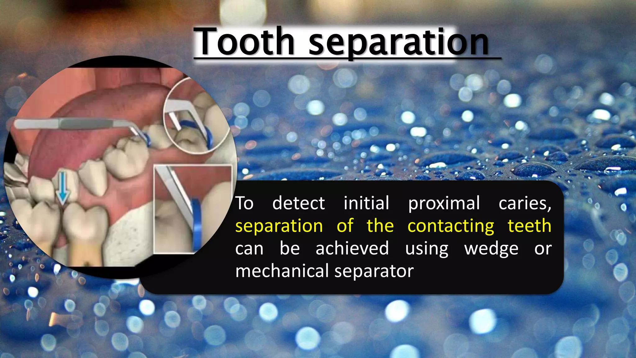 Method Control Caries Diagnosis & treatment of Dental caries | PPTX