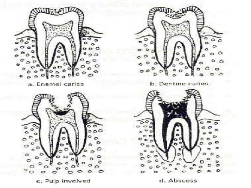 Dental caries ppt