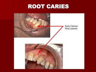 DENTAL CARIES SAVED-1.pdf