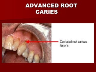Carious Retained Roots DENTAL CARIES SAVED-1.pdf