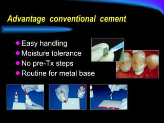 Advantage  conventional  cement Easy handling Moisture tolerance No pre-Tx steps Routine for metal base 
