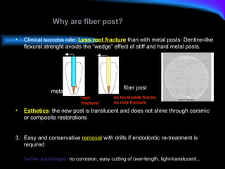 Why are fiber post? Clinical success rate:  Less root fracture  than with metal posts:   Dentine-like flexural strenght avoids the “wedge” effect of stiff and hard metal posts. metal fiber post Esthetics :  the new post is translucent and does not shine through ceramic or composite restorations 3. Easy and conservative  removal  with drills if endodontic re-treatment is required  further advantages :  no corrosion, easy cutting of over-length, light-translucent... root  fracture! no local peak forces,  no root fracture 