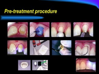 Pre-treatment procedure 