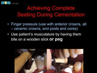 Dental cements and cementation procedures | PDF