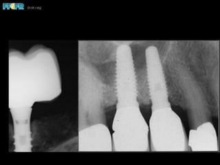 Dental cements and cementation procedures