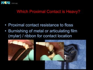 Which Proximal Contact is Heavy?
•  Proximal contact resistance to floss
•  Burnishing of metal or articulating film
(mylar) / ribbon for contact location
 