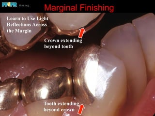 Marginal Finishing
Tooth extending
beyond crown
Crown extending
beyond tooth
Learn to Use Light
Reflections Across
the Margin
 