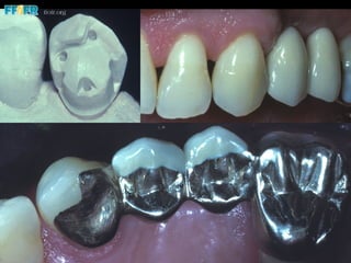 Dental cements and cementation procedures