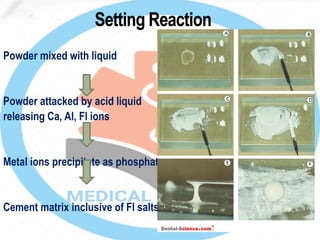 Powder mixed with liquid
Powder attacked by acid liquid
releasing Ca, Al, Fl ions
Metal ions precipitate as phosphate
Cement matrix inclusive of Fl salts
 
