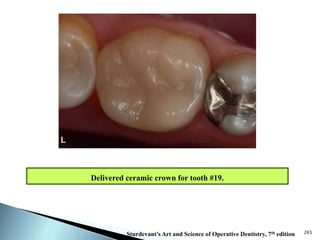Dental Ceramics