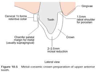 Dental ceramic & cad cam | PPT