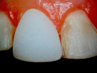 Dental ceramic & cad cam | PPT
