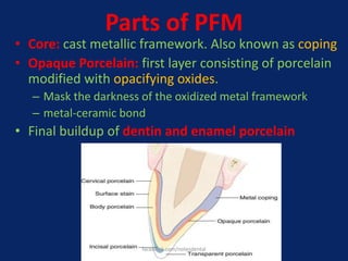 Parts of PFM
• Core: cast metallic framework. Also known as coping
• Opaque Porcelain: first layer consisting of porcelain
modified with opacifying oxides.
– Mask the darkness of the oxidized metal framework
– metal-ceramic bond
• Final buildup of dentin and enamel porcelain
facebook.com/notesdental
 