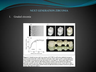 NEXT GENERATION ZIRCONIA
1. Graded zirconia
 