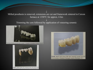 ↓
Milled prosthesis is removed, extensions are cut and framework sintered in Cercon
furnace at 1350°C for approx. 6 hrs
↓
Trimming the core followed by application of veneering ceramic
 