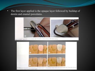 • The first layer applied is the opaque layer followed by buildup of
dentin and enamel porcelains.
 