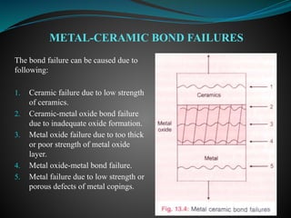 The bond failure can be caused due to
following:
1. Ceramic failure due to low strength
of ceramics.
2. Ceramic-metal oxide bond failure
due to inadequate oxide formation.
3. Metal oxide failure due to too thick
or poor strength of metal oxide
layer.
4. Metal oxide-metal bond failure.
5. Metal failure due to low strength or
porous defects of metal copings.
METAL-CERAMIC BOND FAILURES
 