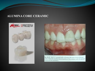 ALUMINA CORE CERAMIC
 