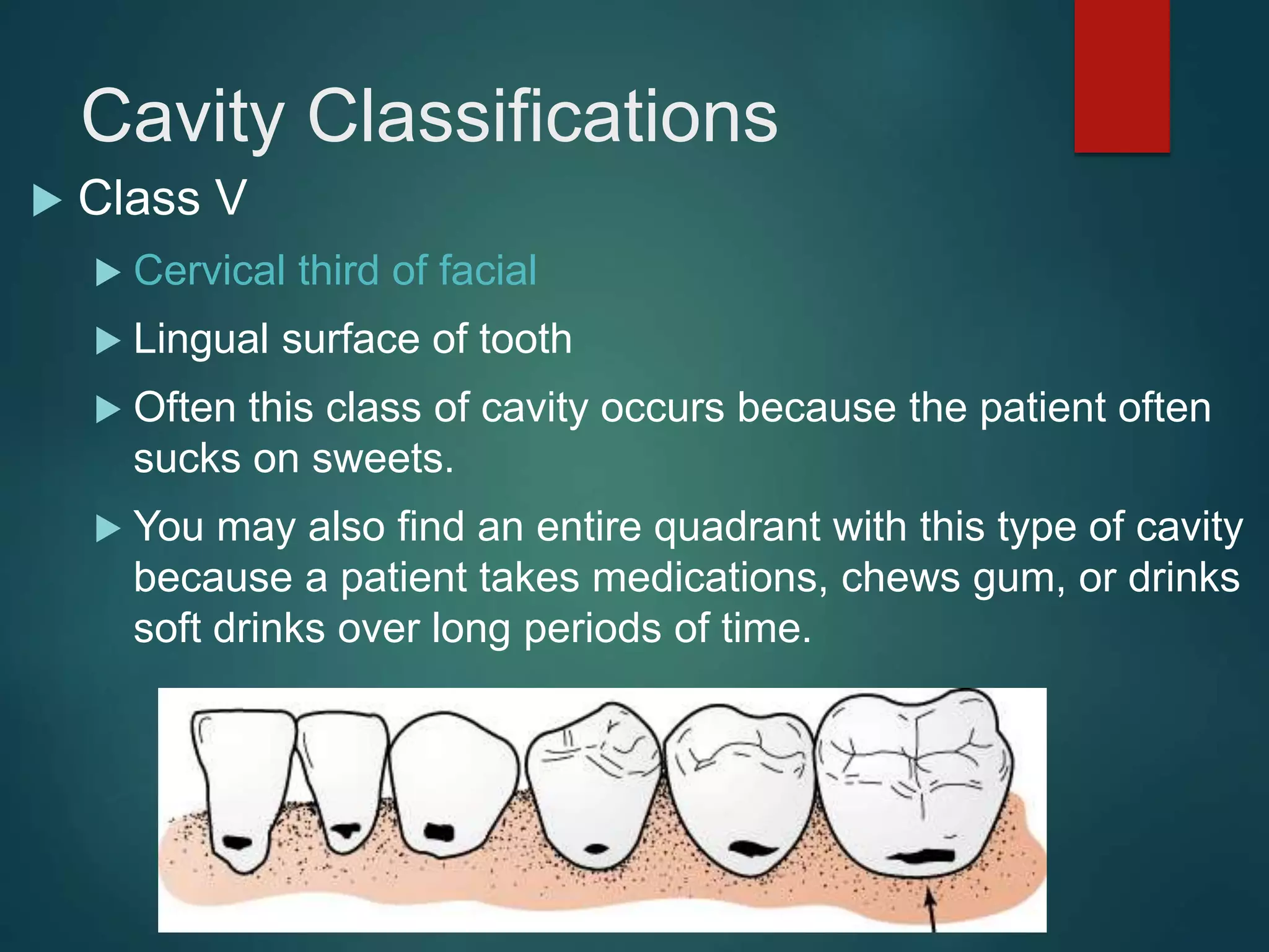 Cavity Classifications
 Class V
 Cervical third of facial
 Lingual surface of tooth
 Often this class of cavity occurs because the patient often
sucks on sweets.
 You may also find an entire quadrant with this type of cavity
because a patient takes medications, chews gum, or drinks
soft drinks over long periods of time.
 