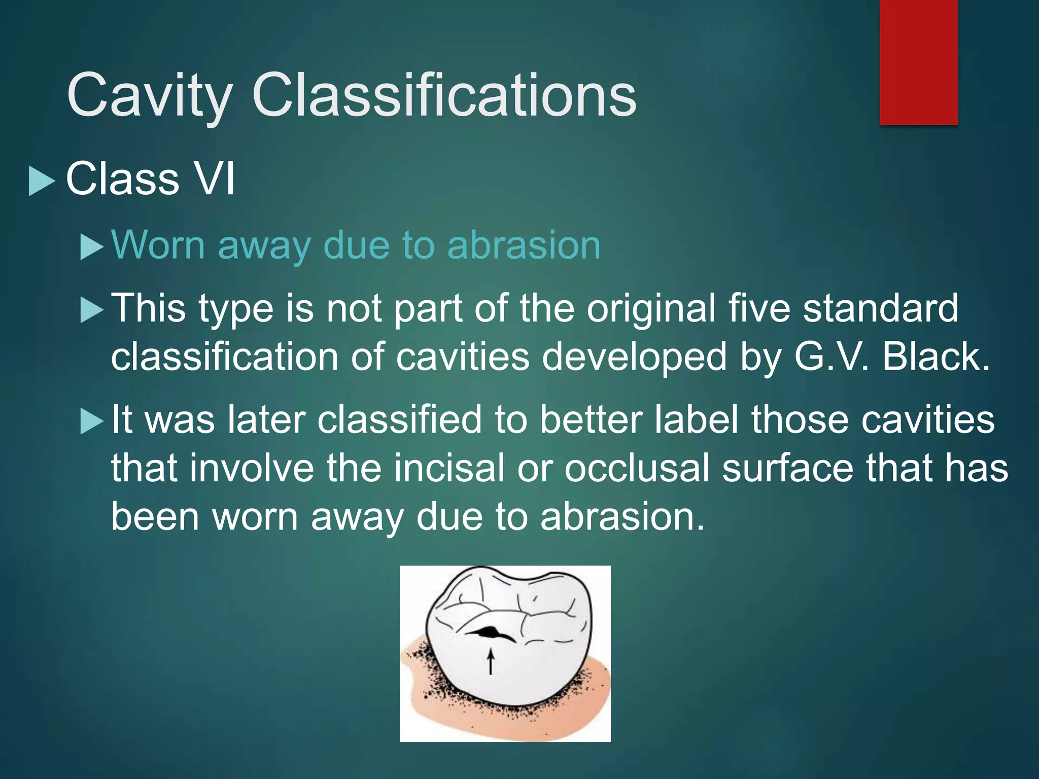 Cavity Classifications
 Class VI
Worn away due to abrasion
This type is not part of the original five standard
classification of cavities developed by G.V. Black.
It was later classified to better label those cavities
that involve the incisal or occlusal surface that has
been worn away due to abrasion.
 