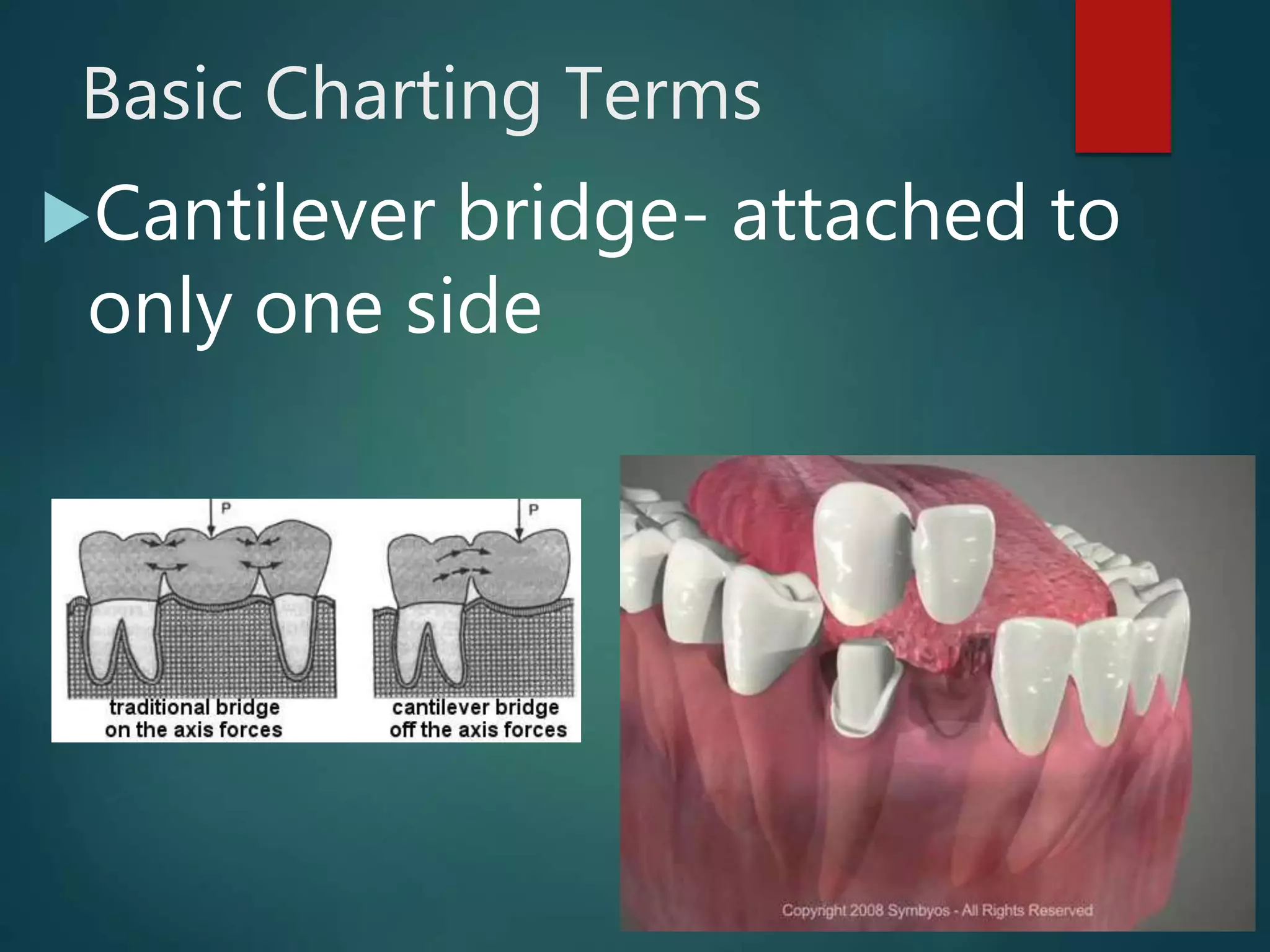 Basic Charting Terms
Cantilever bridge- attached to
only one side
 