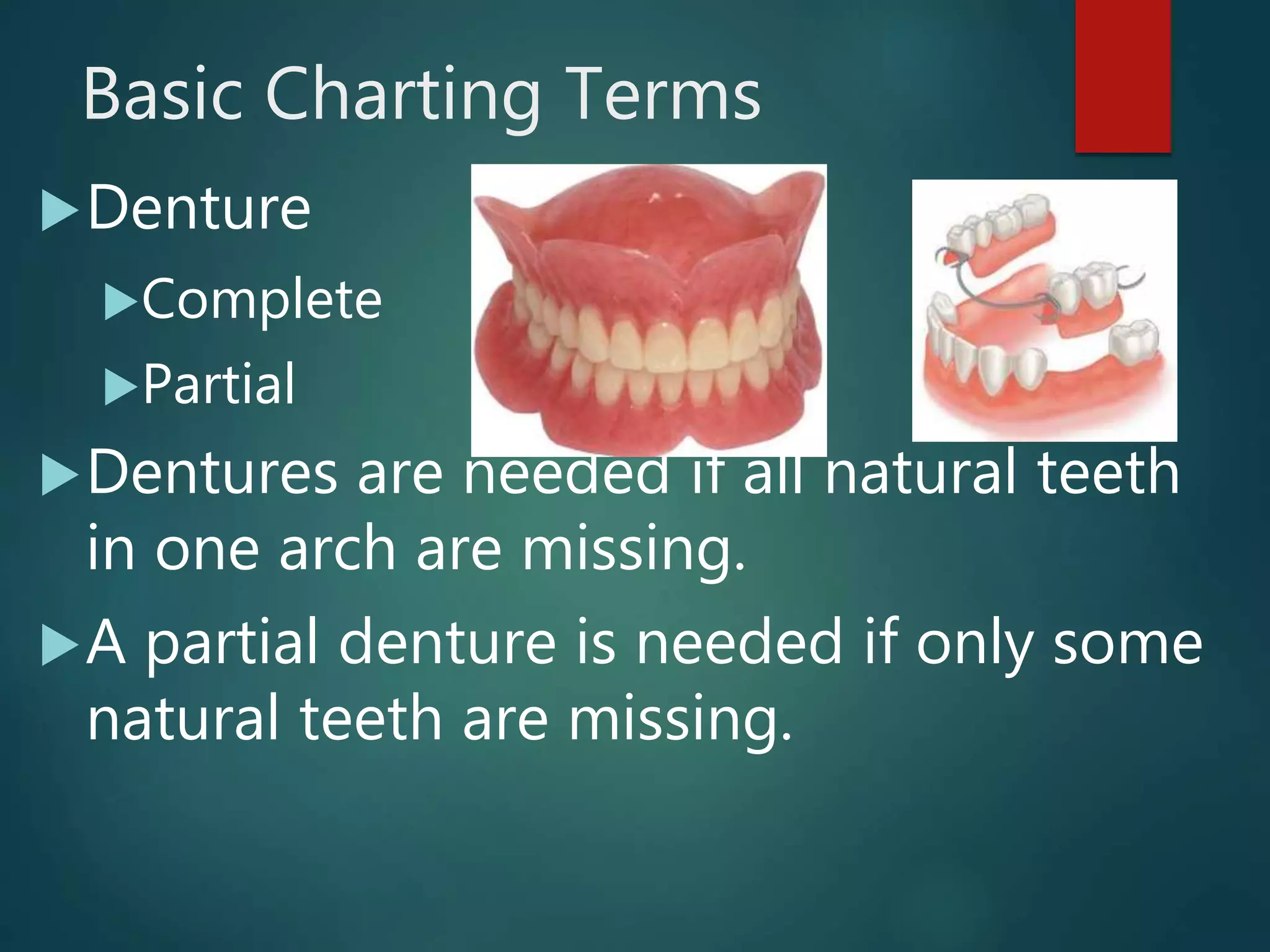 Basic Charting Terms
Denture
Complete
Partial
Dentures are needed if all natural teeth
in one arch are missing.
A partial denture is needed if only some
natural teeth are missing.
 
