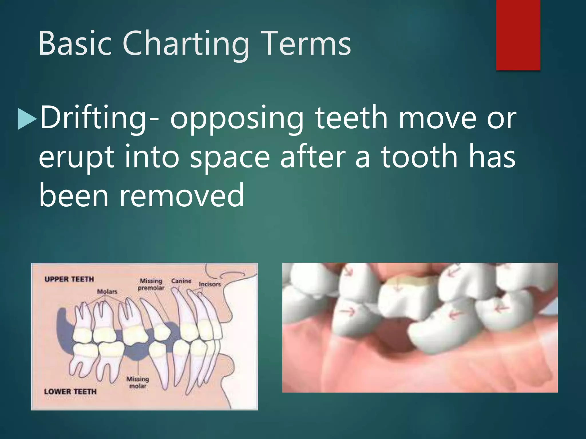 Basic Charting Terms
Drifting- opposing teeth move or
erupt into space after a tooth has
been removed
 
